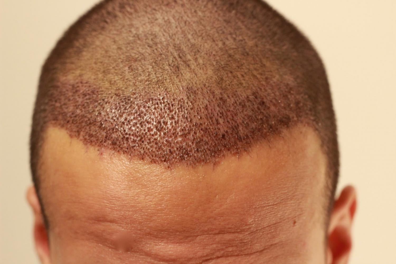 Transplante capilar: Letícia Rizzo dá detalhes da cirurgia que têm feito a cabeça de famosos e anônimos