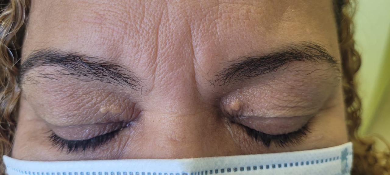 Manchas amareladas no rosto: xantelasma tem tratamento