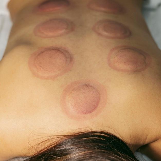 Ventosa e Liberação Miofascial: Malu Ramos explica como a técnica alivia dores musculares