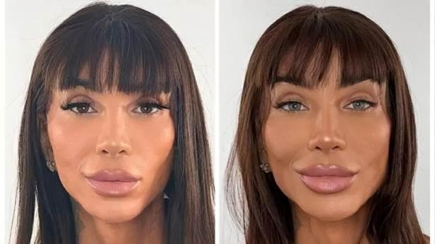 Cirurgia para mudar a cor dos olhos vira 'febre'