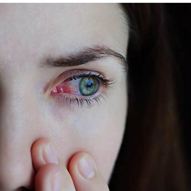 Gripe e resfriado aumentam casos de conjuntivite